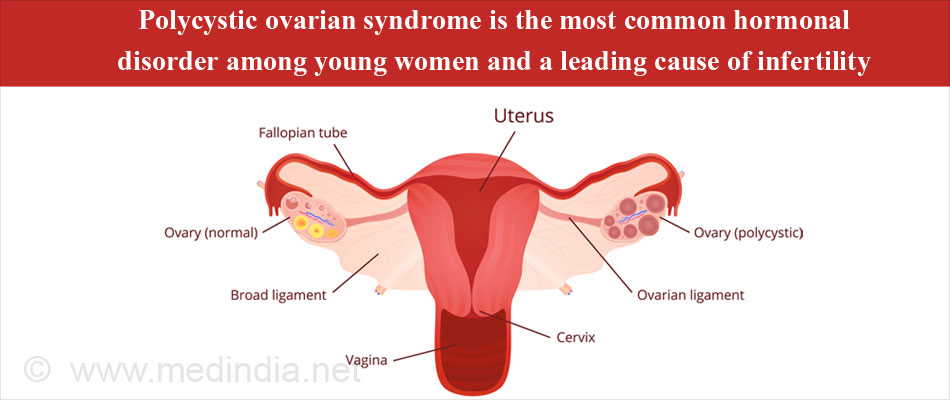 Polycystic Ovarian Syndrome (PCOS) Polycystic Ovarian Syndrome (PCOS)