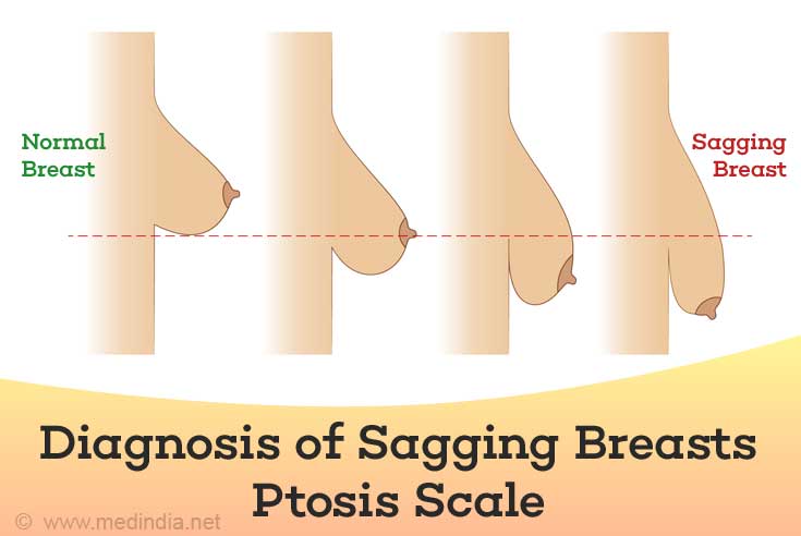 Ptosis Scale Ptosis Scale