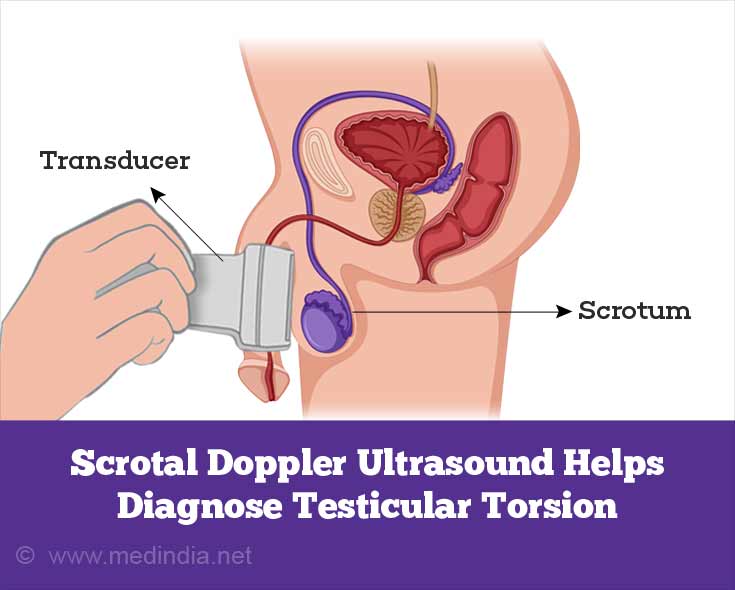 Scrotal Doppler Ultrasound Helps Diagnose Testicular Torsion Scrotal Doppler Ultrasound Helps Diagnose Testicular Torsion