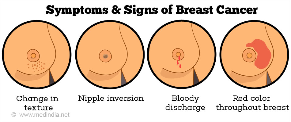 Symptoms & Signs of Breast Cancer Symptoms & Signs of Breast Cancer