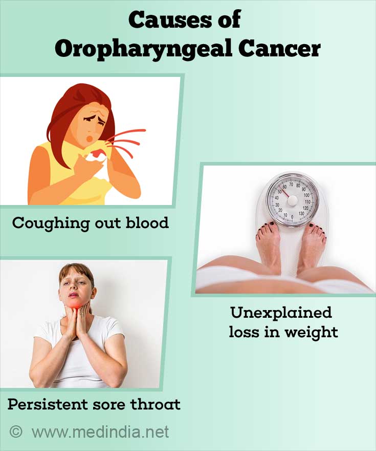 Signs and Symptoms of Oropharyngeal Cancer Signs and Symptoms of Oropharyngeal Cancer