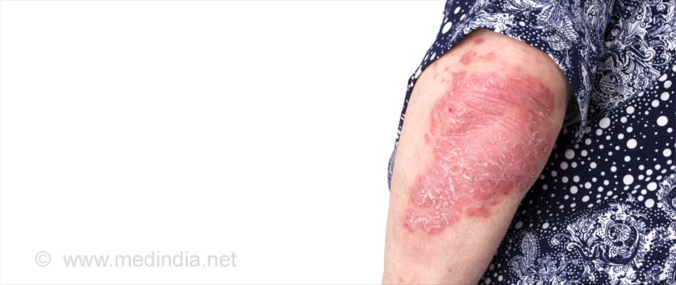 Skin Tuberculosis Skin Tuberculosis