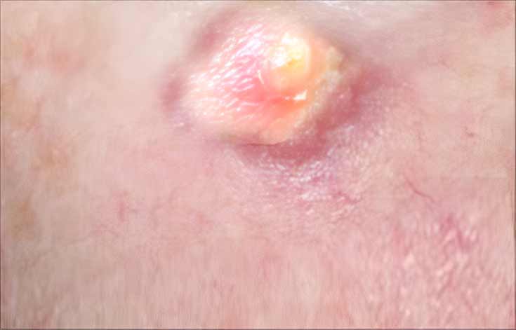 Boils / Skin Abscess Boils / Skin Abscess
