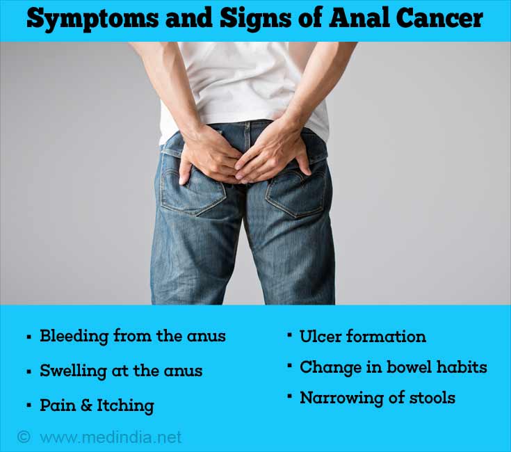 Symptoms and Signs of Anal Cancer Symptoms and Signs of Anal Cancer