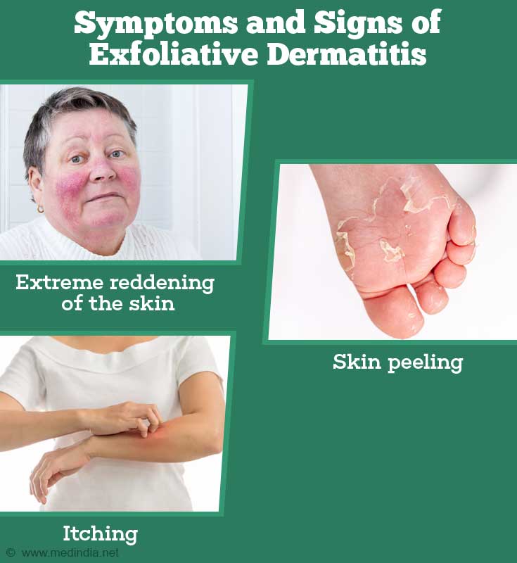 Symptoms and Signs of Exfoliative Dermatitis Symptoms and Signs of Exfoliative Dermatitis