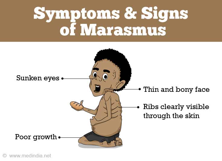 Symptoms and Signs of Marasmus Symptoms and Signs of Marasmus