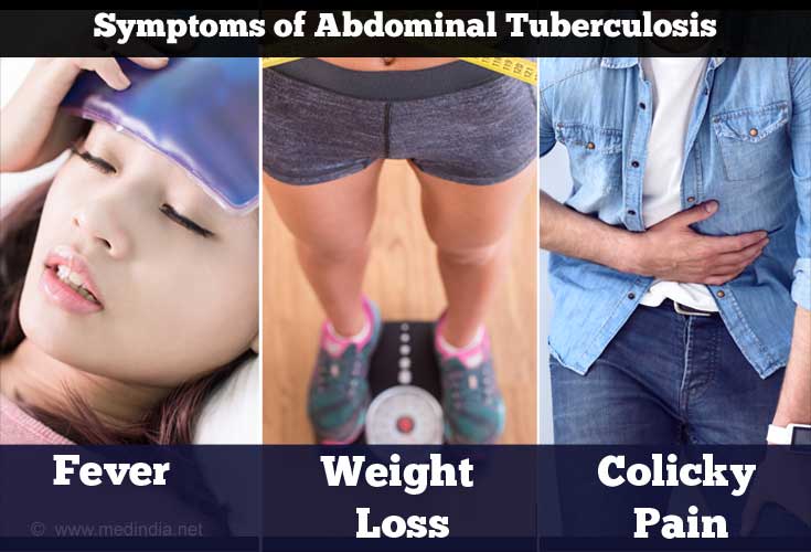 Symptoms of Abdominal Tuberculosis Symptoms of Abdominal Tuberculosis