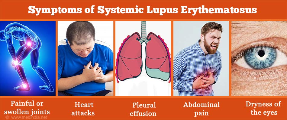 Symptoms of Systemic Lupus Erythematosus Symptoms of Systemic Lupus Erythematosus