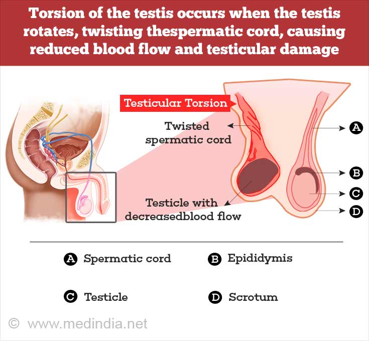 Torsion of the Testis Torsion of the Testis