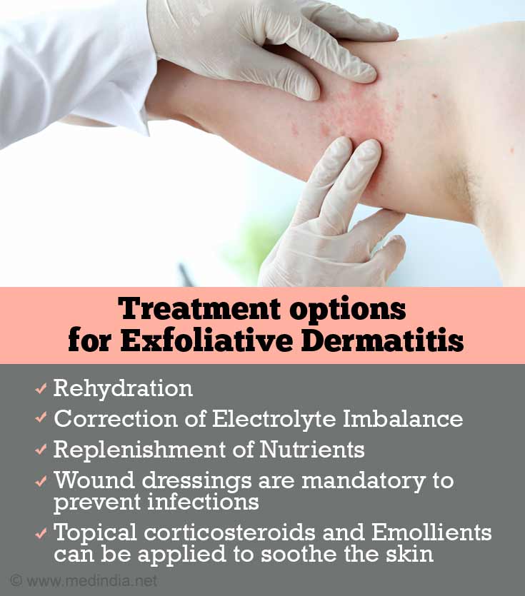 Treatment options for Exfoliative Dermatitis Treatment options for Exfoliative Dermatitis