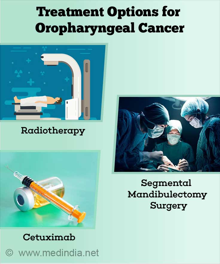 Treatment Options for Oropharyngeal Cancer Treatment Options for Oropharyngeal Cancer