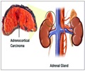 Adreno Cortical Carcinoma - Symptoms-Diagnosis-Treatment-Prognosis