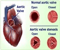 Aortic Valve Stenosis - Causes - Symptoms - Diagnosis - Replacement