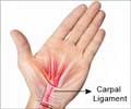 Carpal Tunnel Syndrome-Causes-Signs-Symptoms-Diagnosis-Treatment-Prevention Carpal Tunnel Syndrome-Causes-Signs-Symptoms-Diagnosis-Treatment-Prevention