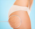 Cellulite Treatment - Causes, Risk Factors, Treatment, Alternative Medicines