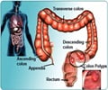 Colon Polyps-Causes-Symptoms-Diagnosis-Treatment-Prevention-Complications