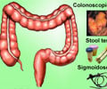 Colorectal Cancer Screening
