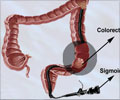 Colorectal Cancer Screening with Flexible Sigmoidoscopy