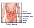 Crohn’s Disease