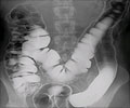 Colorectal Cancer Screening with Double-Contrast Barium Enema