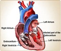 Infective Endocarditis-Causes-Symptoms-Diagnosis-Complications-Treatment