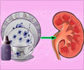Kidney Failure due to Melamine Toxicity