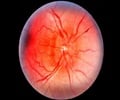 Optic Neuritis-Causes-Symptoms-Signs-Treatment-Prevention-Complications Optic Neuritis-Causes-Symptoms-Signs-Treatment-Prevention-Complications