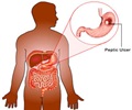 Peptic Ulcer