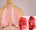 Pneumoconiosis - Definition - Symptoms - Causes - Prevention - Treatment Pneumoconiosis - Definition - Symptoms - Causes - Prevention - Treatment
