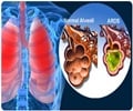Acute Respiratory Distress Syndrome - Causes Diagnosis Treatment Complications FAQ