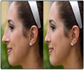 Rhinoplasty