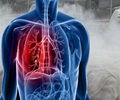 Silicosis-Causes-Types-Symptoms-Signs-Complications-Diagnosis-Treatment Silicosis-Causes-Types-Symptoms-Signs-Complications-Diagnosis-Treatment