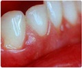 Understanding Swollen Gums: Causes and Solutions