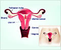 Uterine Cancer / Endometrial Cancer - Symptoms - Risk Factors – Prognosis - Treatment
