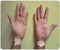 Vitiligo-Symptoms-Diagnosis-Treatment-Research-Lifestyle