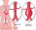 Abdominal Aortic Aneurysm - Causes, Types, Symptoms, Complications, Diagnosis & Treatment