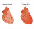 Pericarditis - About  Causes  Symptoms and Signs  Diagnosis  Treatment