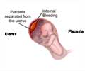 Abruptio Placenta