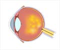 Age Related Macular Degeneration (AMD) - Causes, Symptoms, Diagnosis, Treatment & Prevention