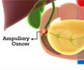 Ampullary Cancer | Cancer of the Ampulla of Vater: Frequently Asked Questions