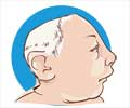 Anencephaly - Causes, Symptoms, Diagnosis and Treatment