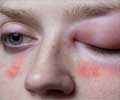 Angioedema - Causes, Symptoms, Diagnosis & Treatment