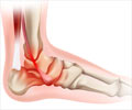Ankle Pain - Symptom Evaluation