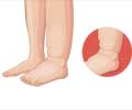 Ankle Edema / Ankle Swelling - Causes FAQs