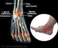 Ankle Injuries and Disorders