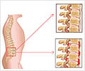 Ankylosing Spondylitis - Causes Symptoms Diagnosis Treatment FAQs