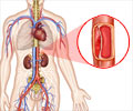Aortic Dissection | Aortic Aneurysm - Types, Causes, Symptoms, Diagnosis, Treatment