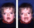 Apert Syndrome - Causes, Symptoms, Diagnosis & Treatment