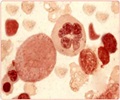 Aplastic Anemia