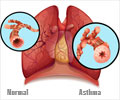 Asthma in Children and Adults - Facts, Treatment and Symptoms